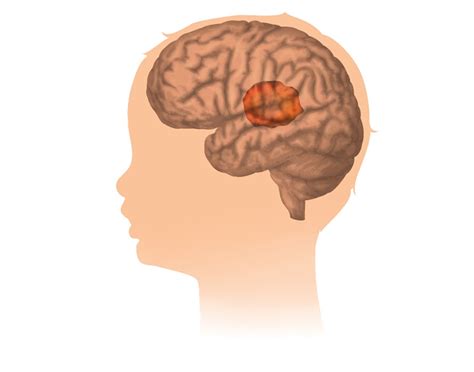 Beyin tumorunde son asama